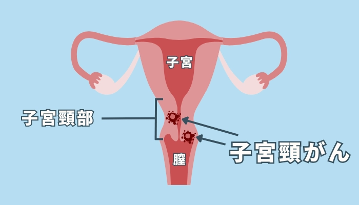 子宮頸がんは子宮のどこにできるがん？