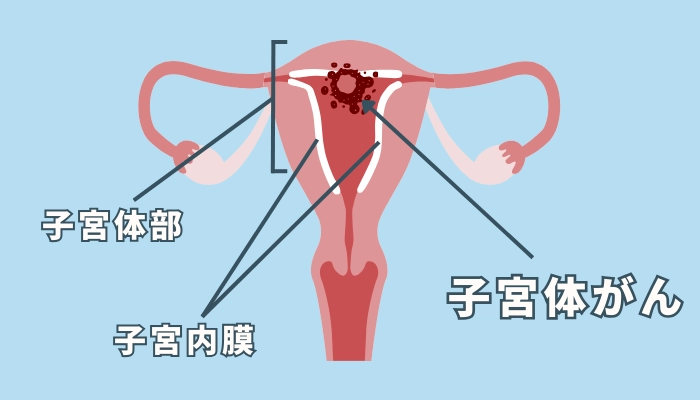 子宮内膜の位置や子宮体がんを説明するイラスト