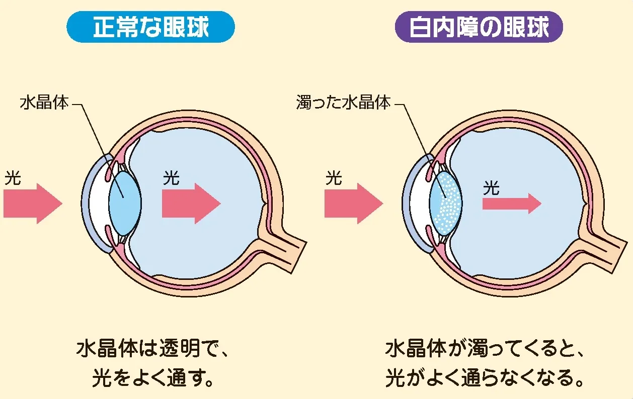 白内障とは