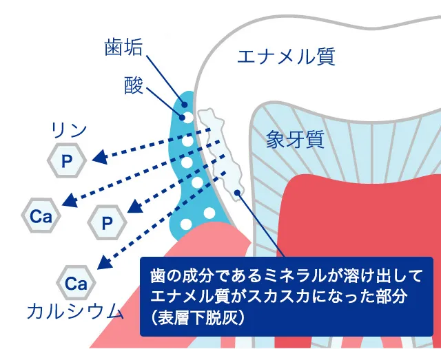 初期の虫歯の状態