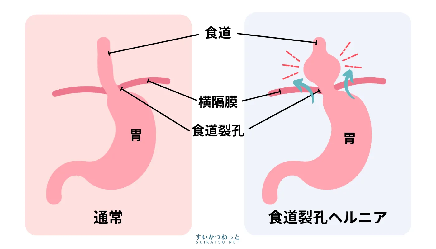 食道裂孔ヘルニアってどんな病気？すいかつねっとのイラスト解説